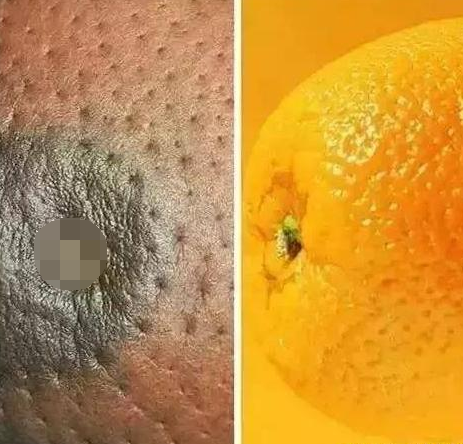 都是针对 乳腺癌 的情况来描述的,如果您的乳房皮肤出现了像"橘子皮"