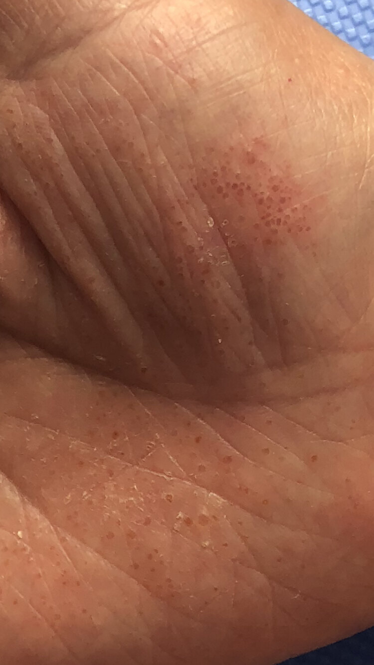 云健健 > 汗疱疹(手部皮肤病2) 典型表现为手掌,手指侧缘对称性的水疱