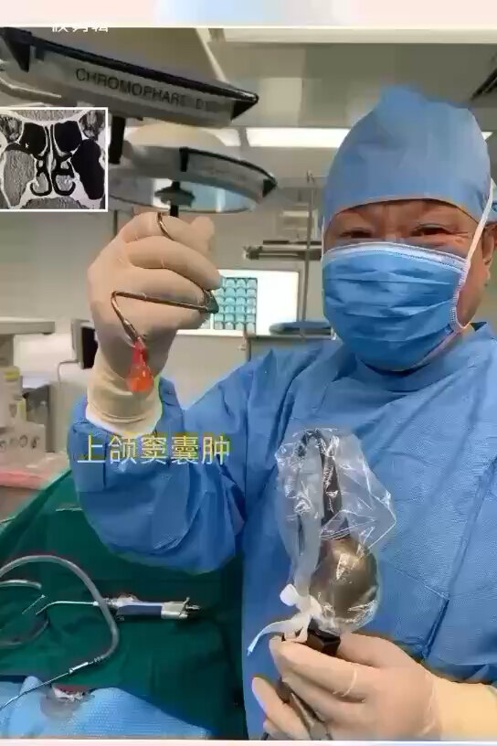 上颌窦囊肿的手术治疗