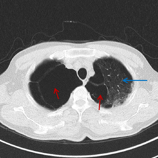 遂来我院就诊,查胸部ct可见双肺广泛肺大泡,右肺肺大泡较左侧更为明显