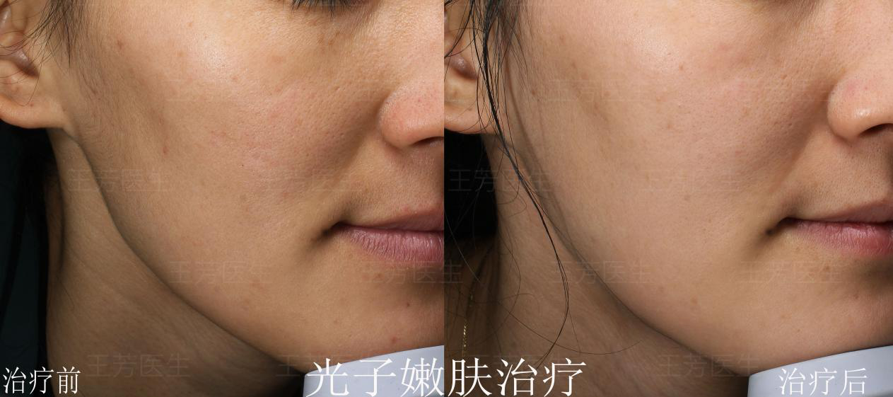 王芳 光子嫩肤效果对比案例分享下图为光子嫩肤治疗前后的对比照片