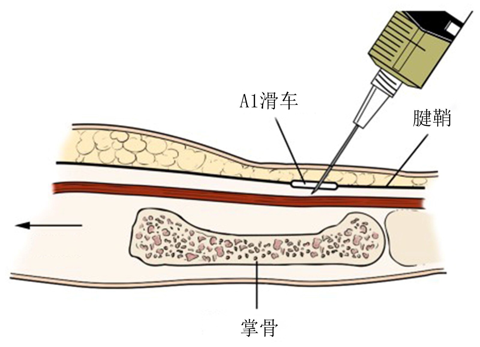 少玩手机多读书,避免扳机指和拇