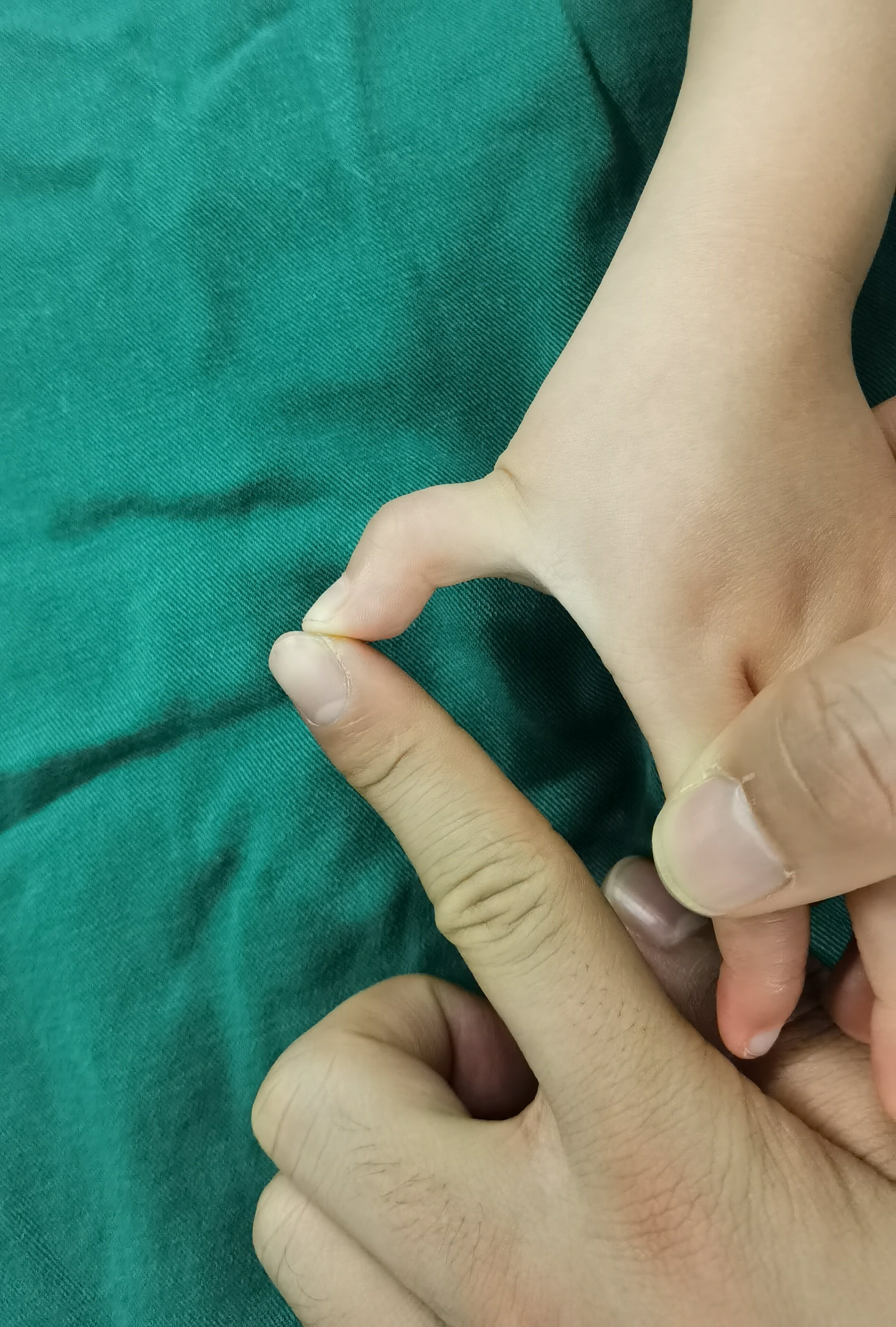 4周岁小朋友拇指腱鞘炎