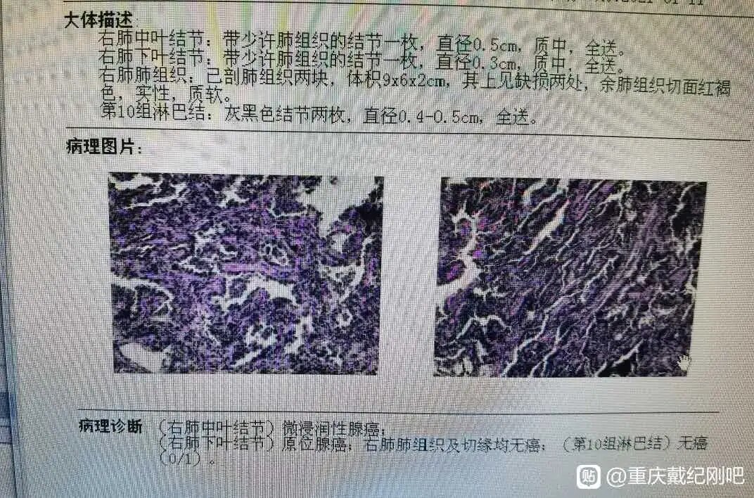 "身处冰冷的手术室,忍不住全身颤抖",医生的温度让浙江肺结节患者感动