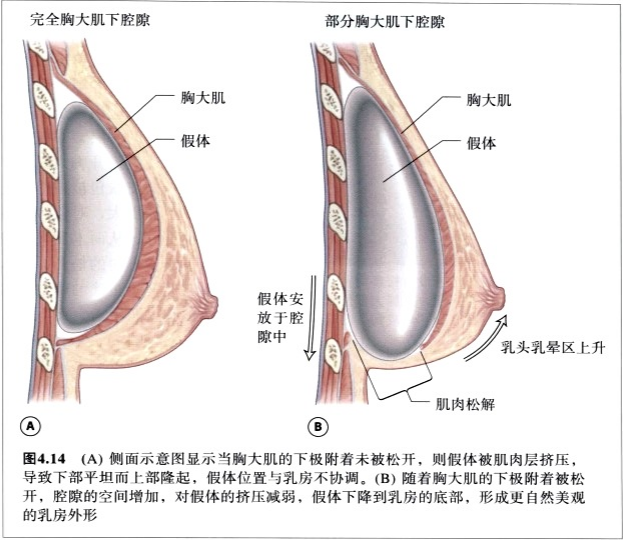 假体植入层次