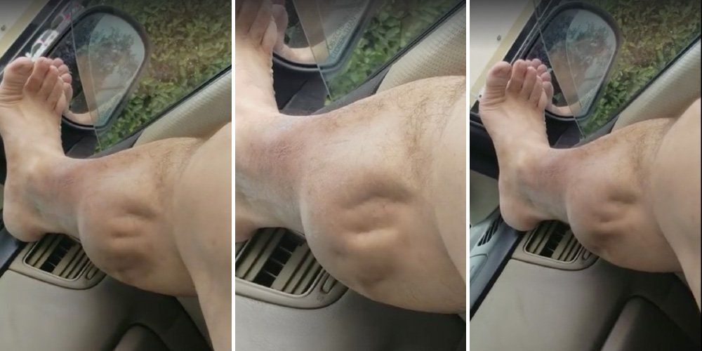 肌肉痉挛或抽筋是指小腿肌肉非自愿收缩,无法放松,不受自己控制,同时