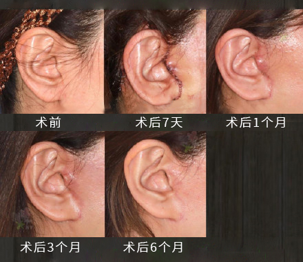 仅供参考上图是拉皮手术后第7天,1个月,3个月,6个月时,耳前切口的恢复