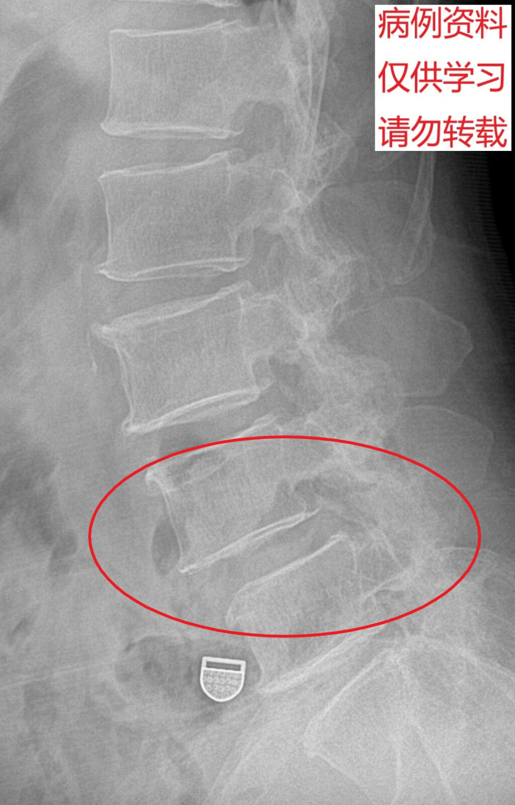 术前检查结果如下: 上述两图为术前腰椎正侧位x线影像.