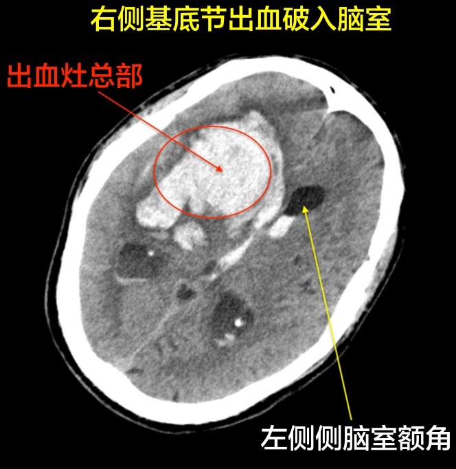 脑室出血