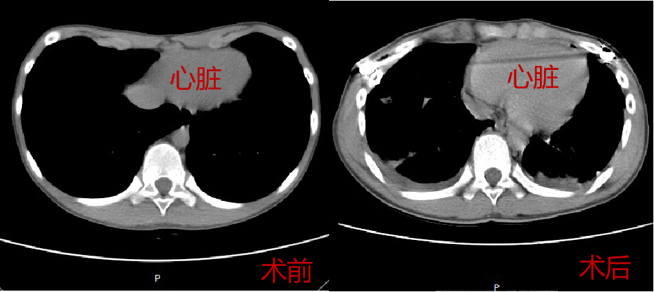 12岁漏斗胸微创手术治疗!