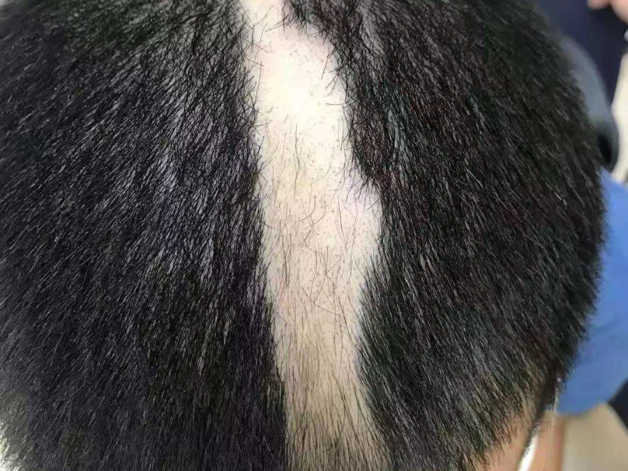 儿童脱发小心拔毛癖