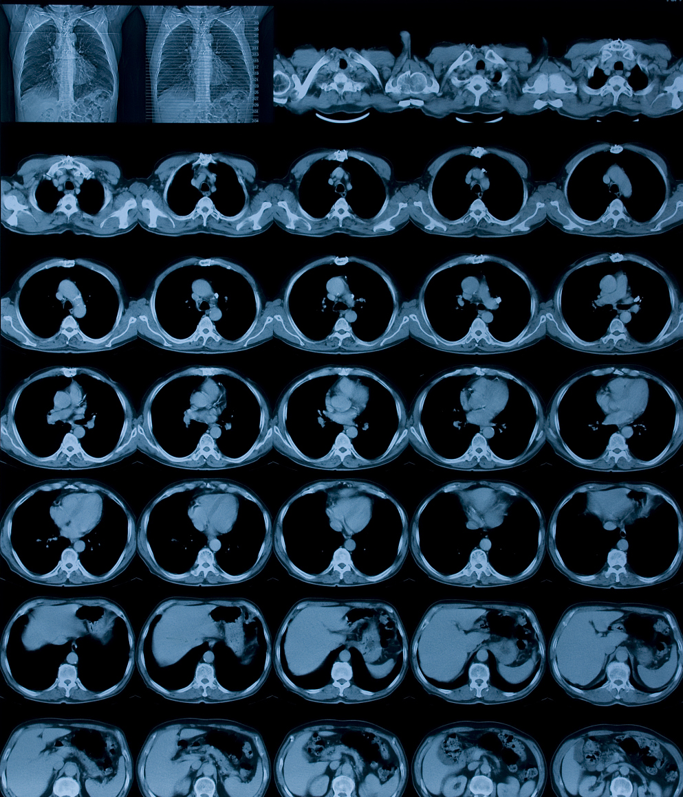 肺部小结节常见问题问答(四)——可以吃中药不?可以先