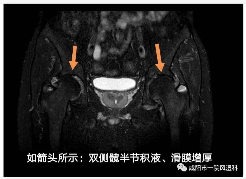 (四)外周关节:双侧髋关节受累.