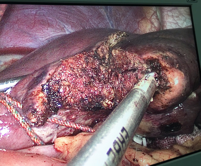 肝癌能做微创手术吗?