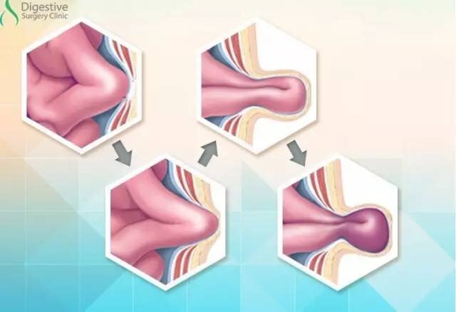 腹腔镜疝修补竟然不是微创手术! - 好大夫在线