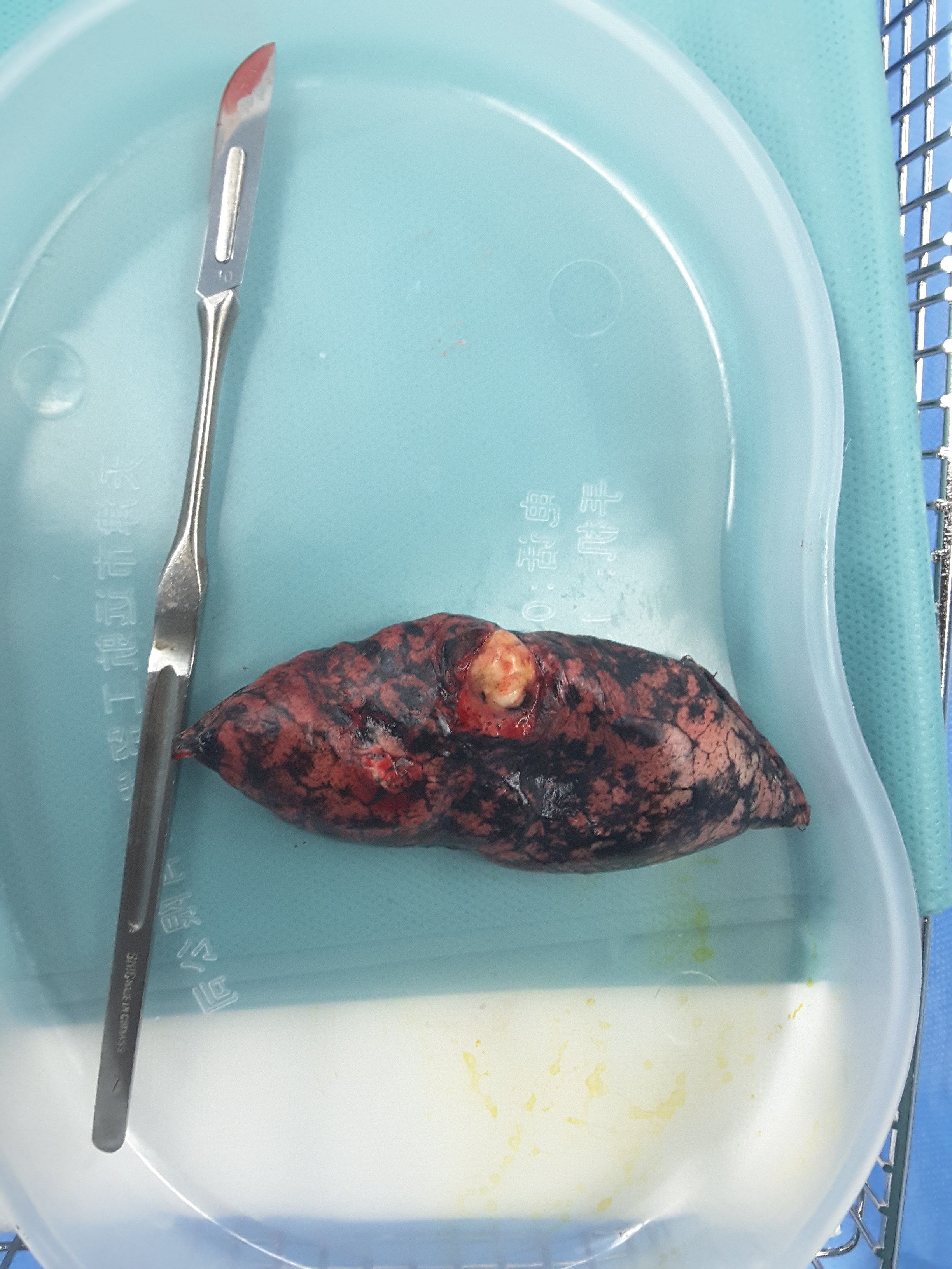 刘懿博士说肺癌(二二八)肺错构瘤该不该切?_肺