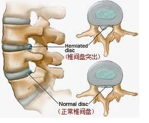 马尾压迫神经自我疗法