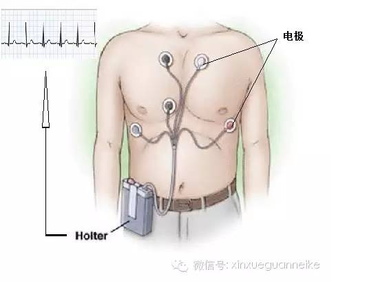 过速 患者须知基础篇其他可能的检查有 动态心电图监测(holter)