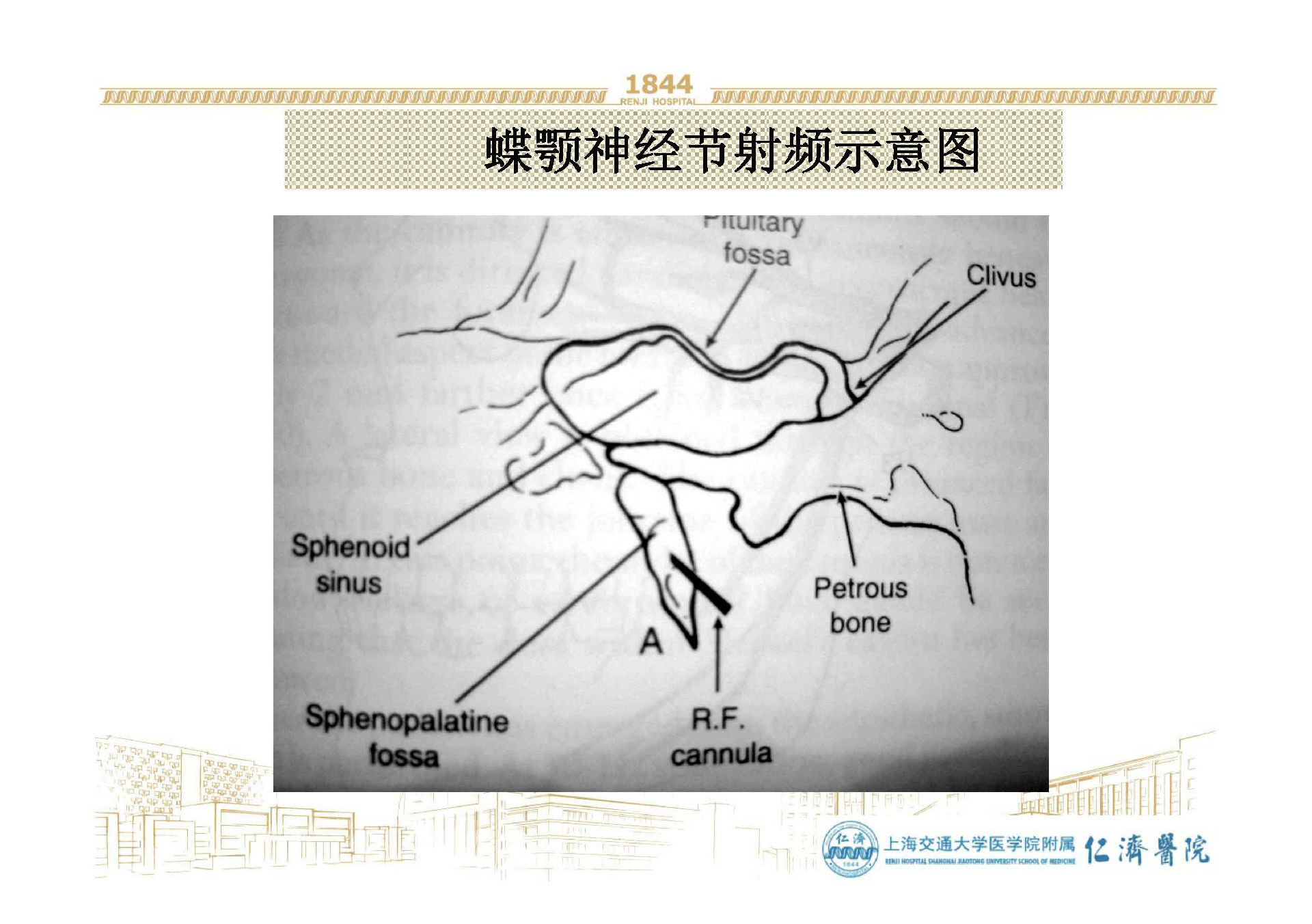 与蝶腭神经节有关的头面痛