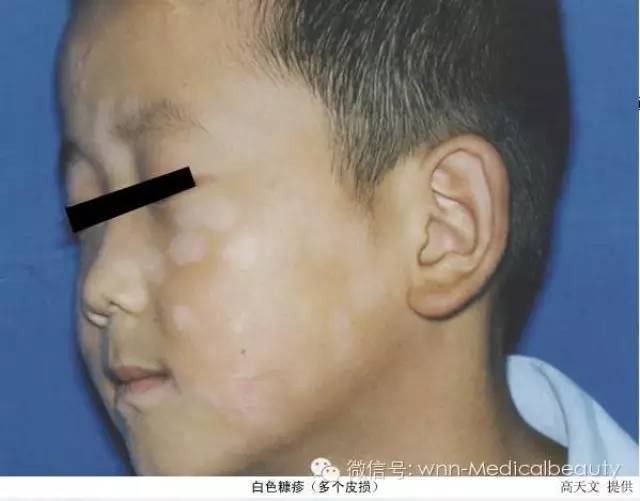 脸上有白斑一定是白癜风吗?_白色糠疹_疾病介