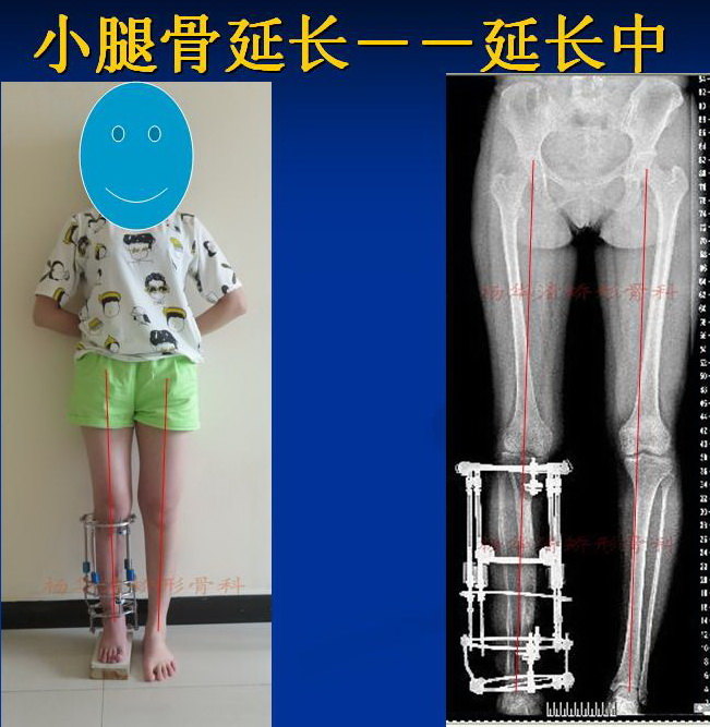 小腿骨延长(胫腓骨延长术)杨华清矫形骨科