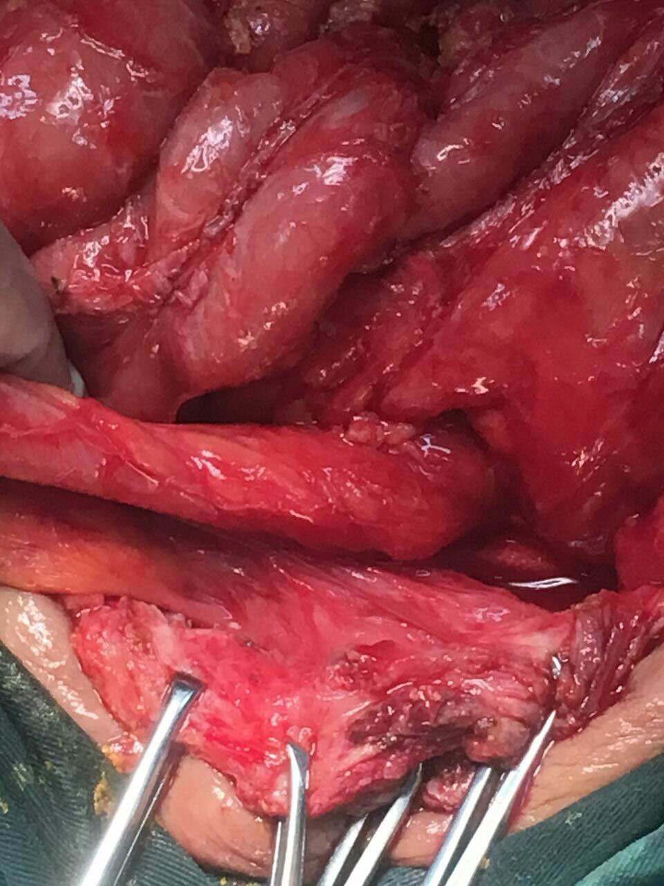粘连性肠梗阻术中见小肠粘连致密呈茧状分离困难