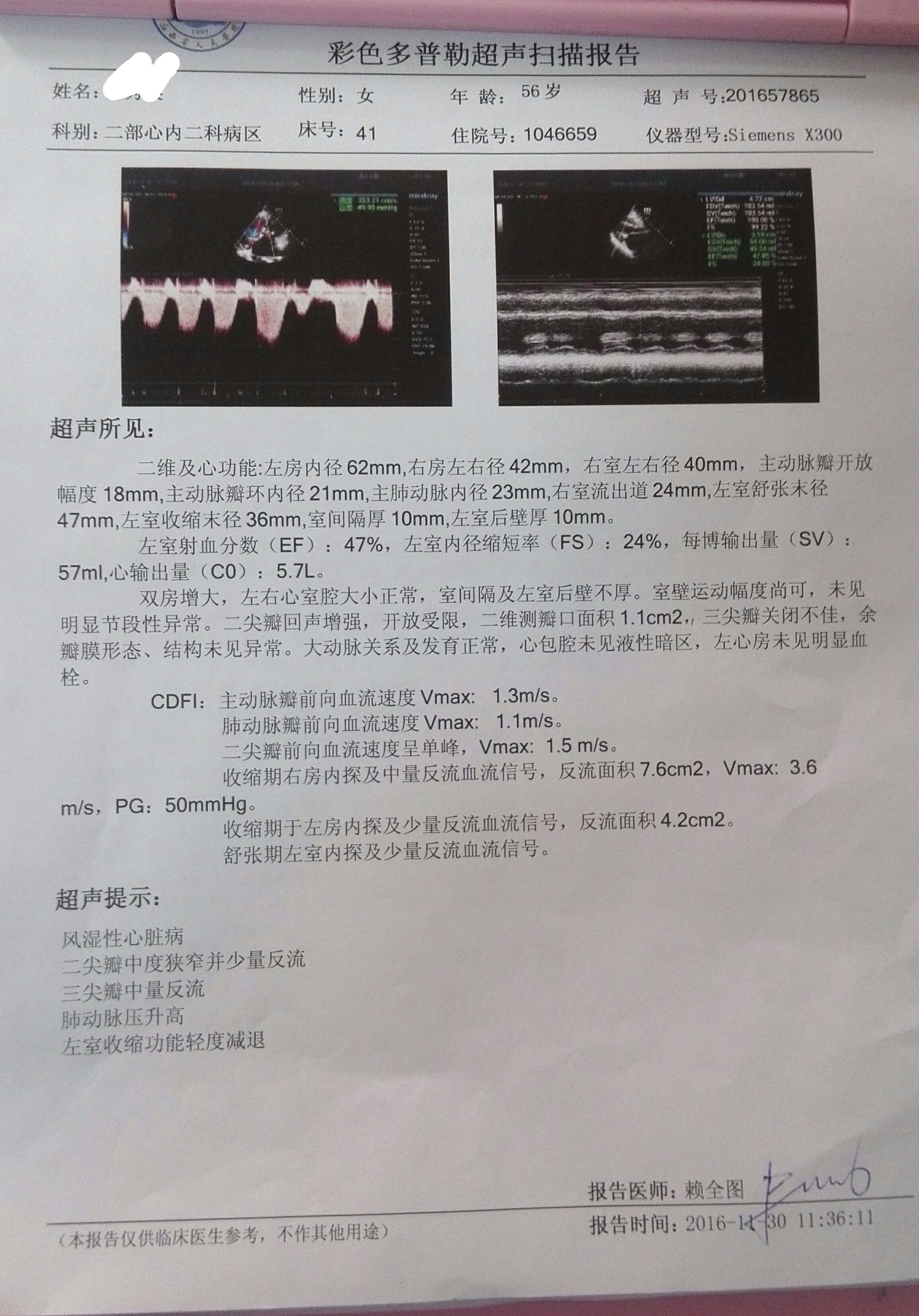 二尖瓣狭窄的微创治疗