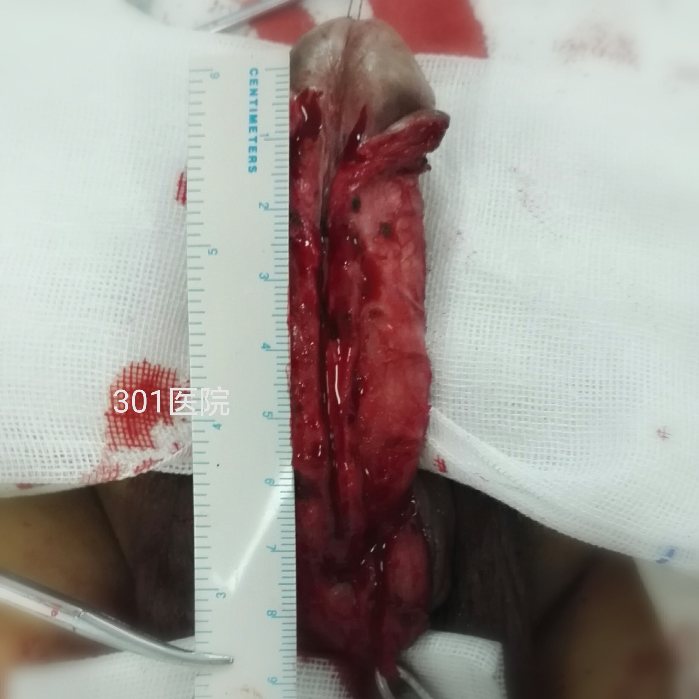 包皮瓣尿道成形术治疗前尿道狭窄