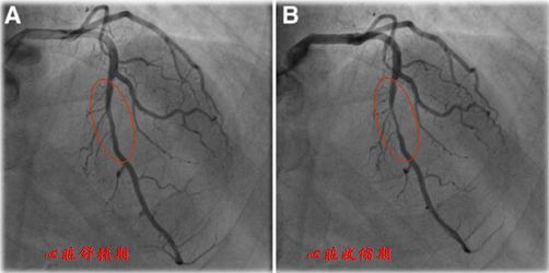 心肌桥-冠脉造影.JPG