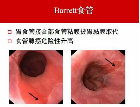 barrett食管不等于食管癌