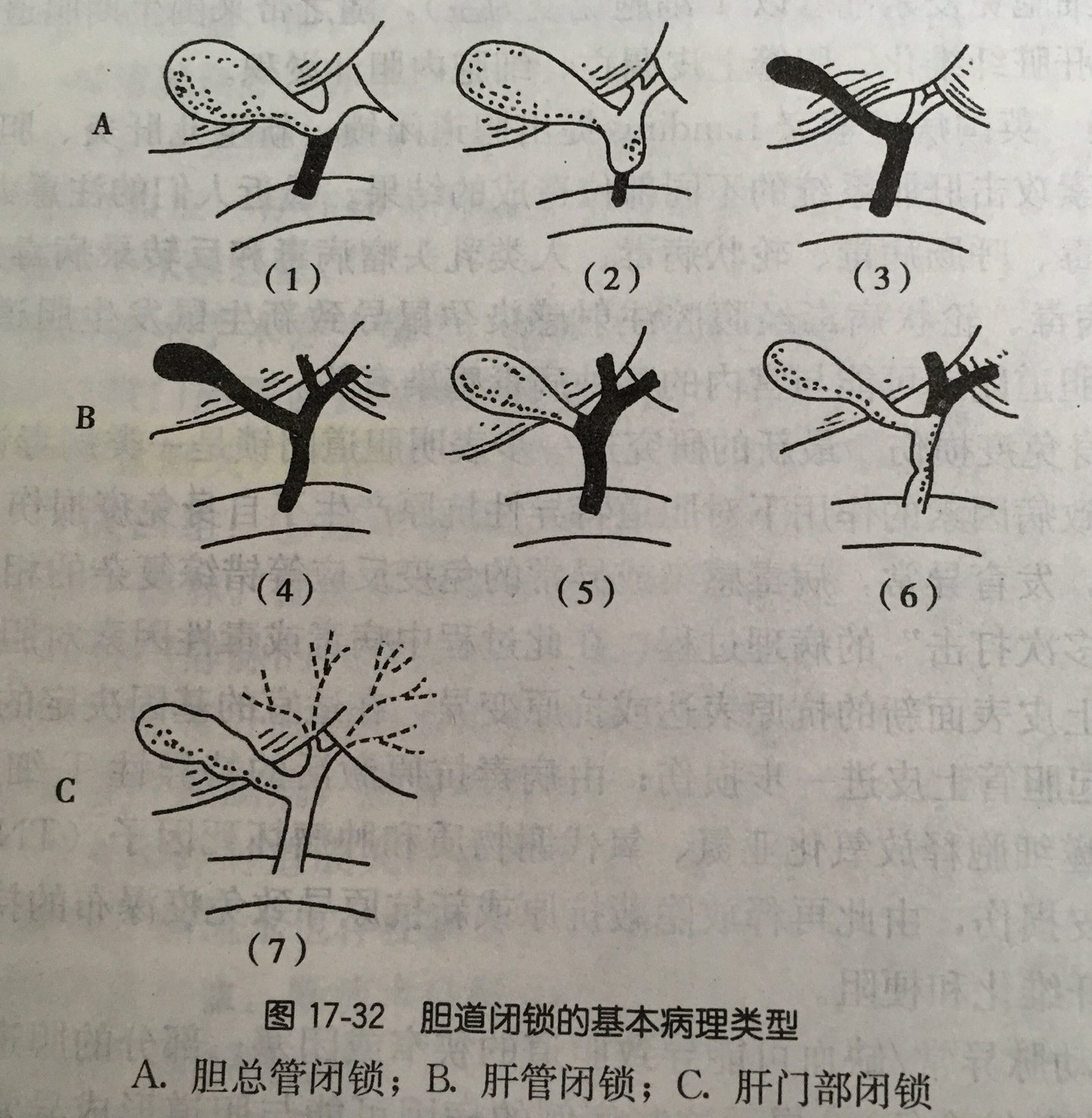 新生儿黄疸之胆道闭锁:经常忽视,其实要高度警惕.