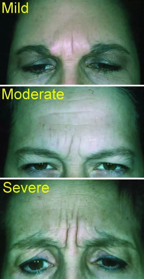 肉毒素除皱的关键在这几个注射点