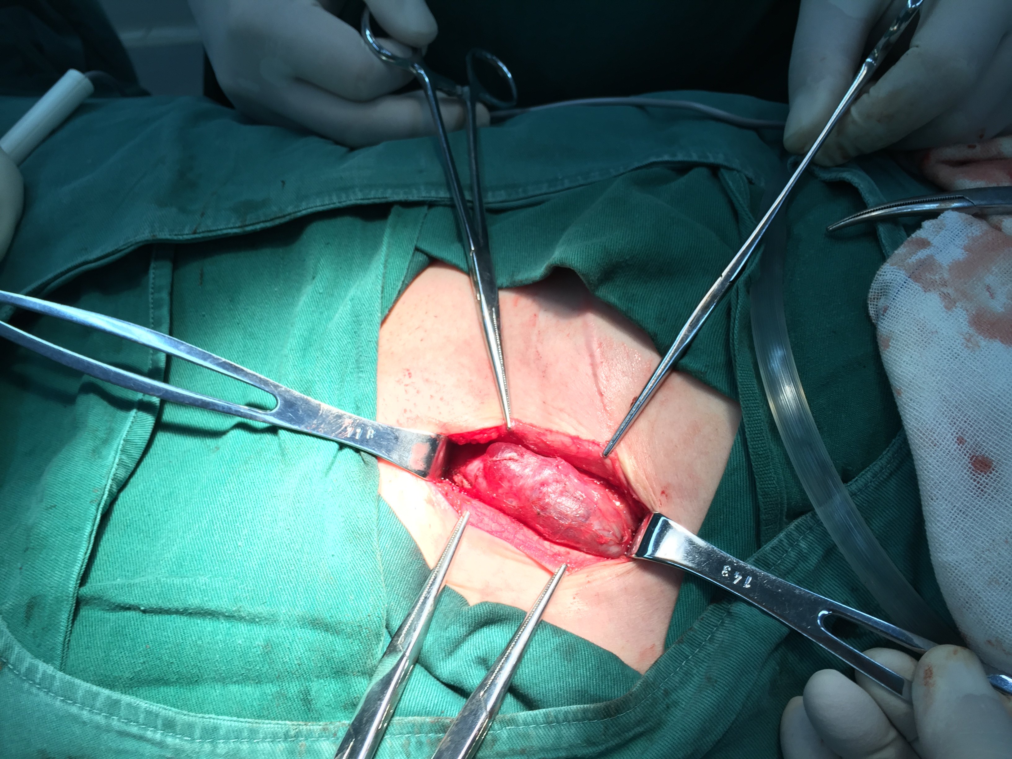 女性腹股沟少见常误诊为疝---子宫圆韧带囊肿