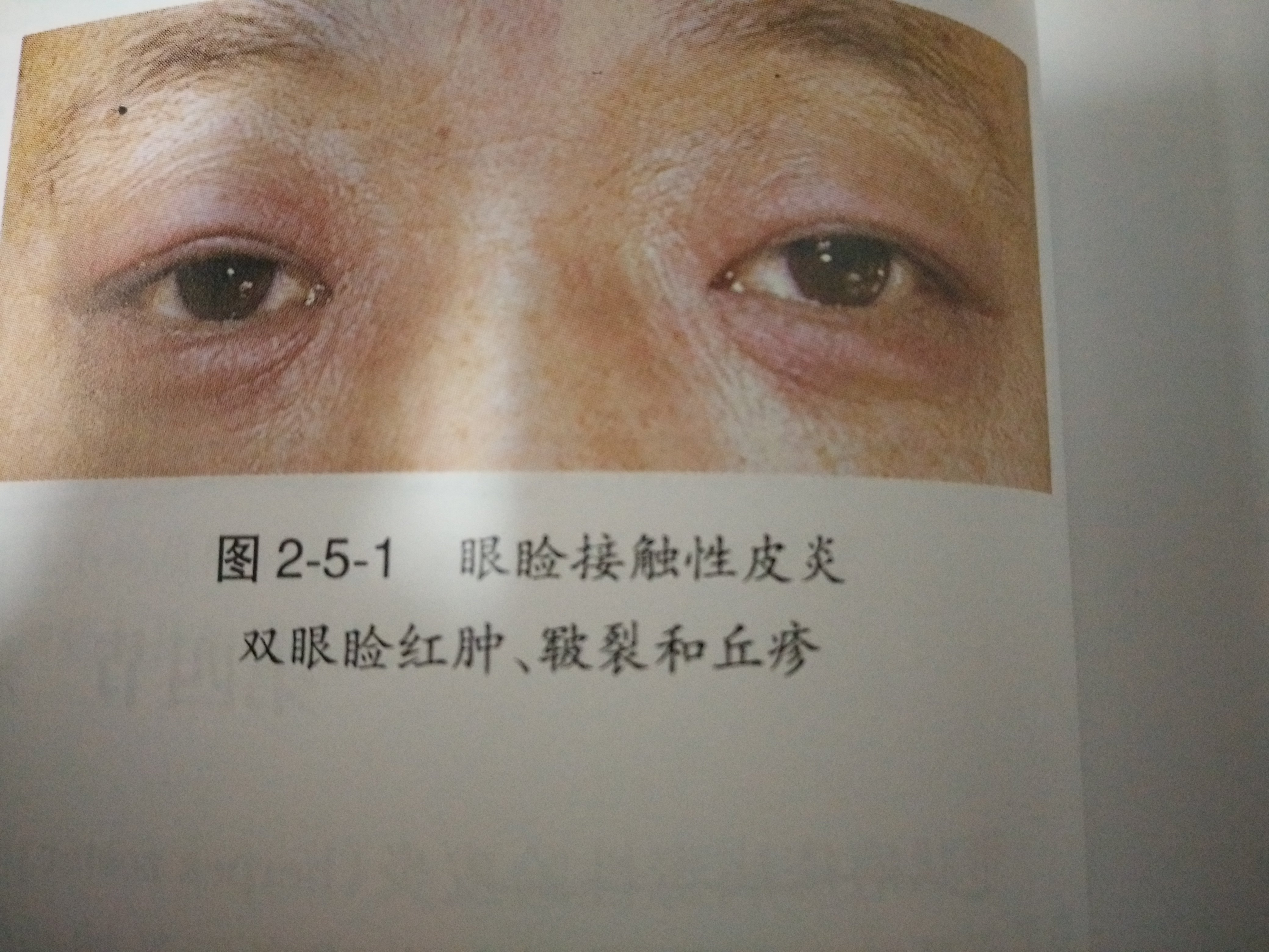 眼睑接触性皮炎的眼外表现.