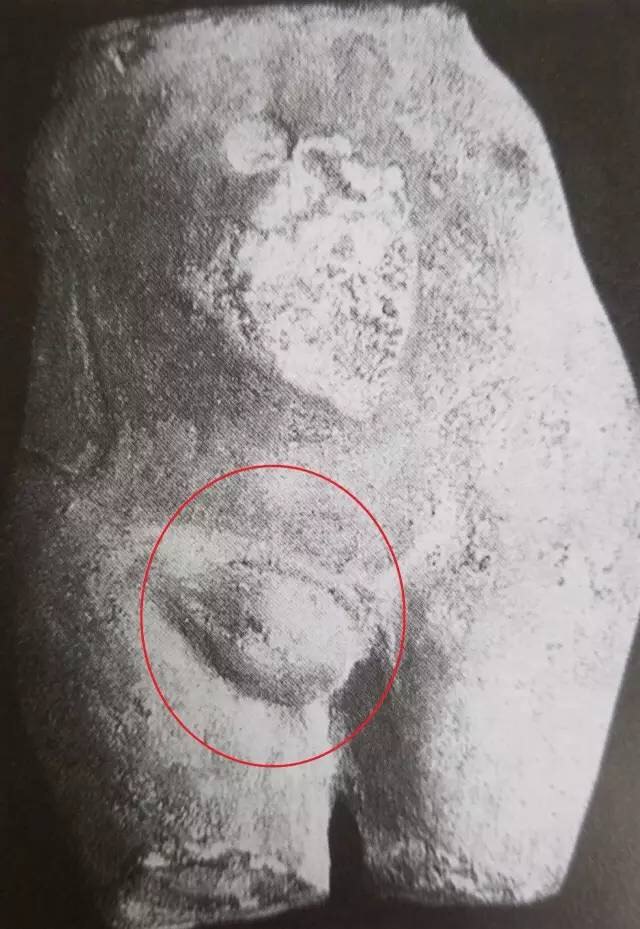 腹腔镜疝修补竟然不是微创手术! - 好大夫在线