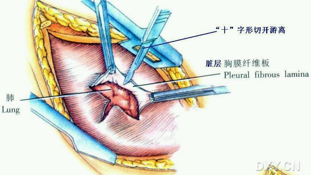 胸膜纤维板剥脱术