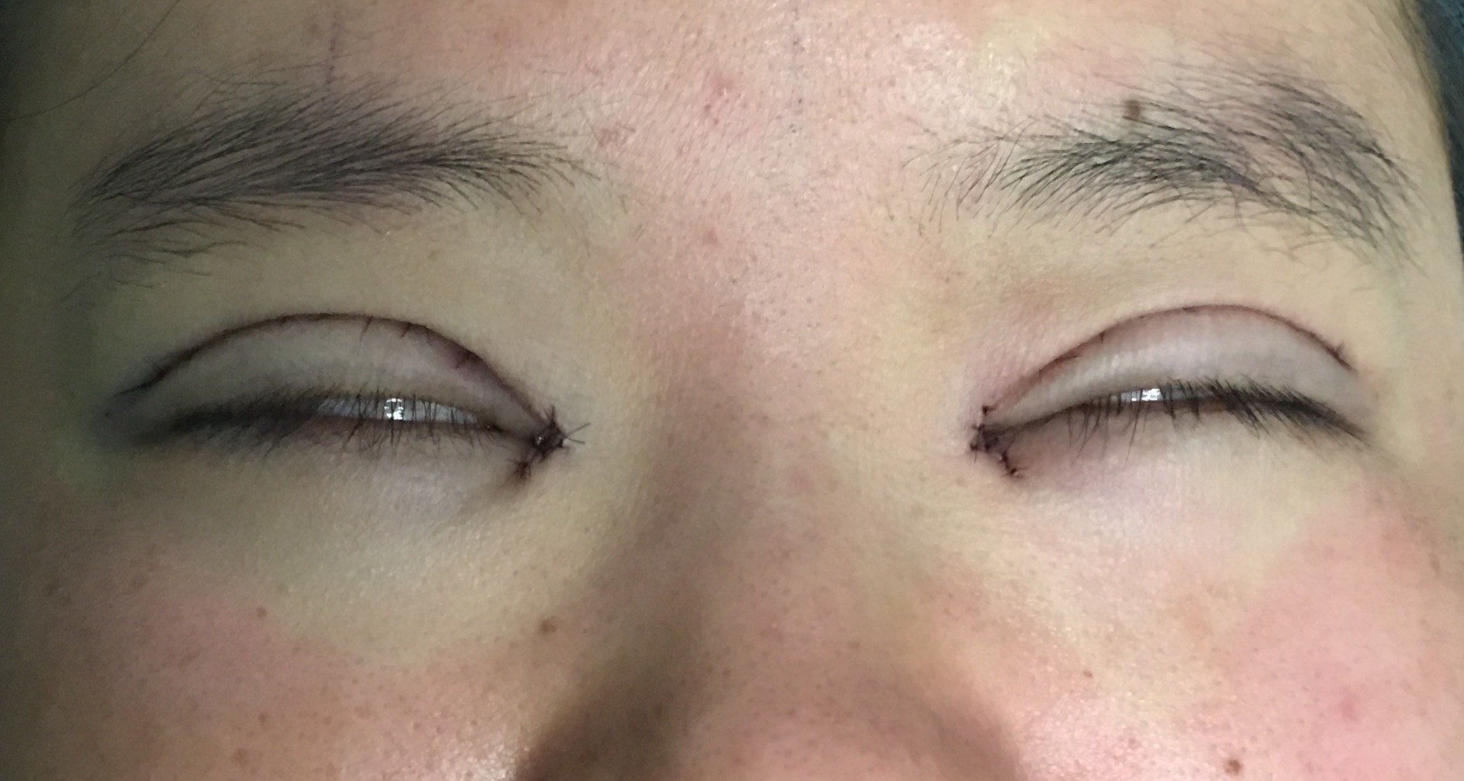 双眼皮切开术后动态恢复过程