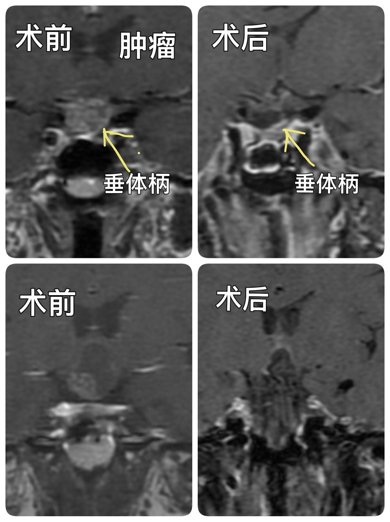 眉间锁孔切除颅咽管瘤-窦以河-青大附院