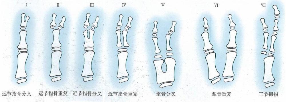 小儿六指畸形的类别和治疗方法?