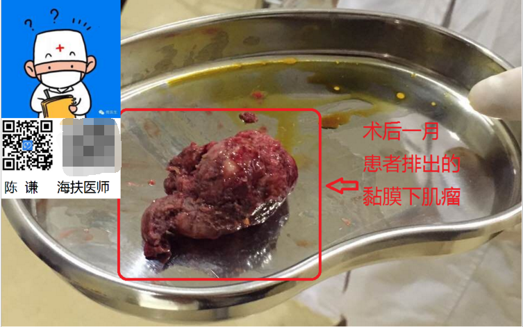 海扶超声消融治疗肌瘤后转归之排出篇