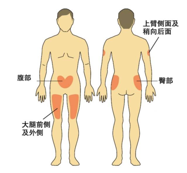 身体哪些部位可以注射胰岛素?