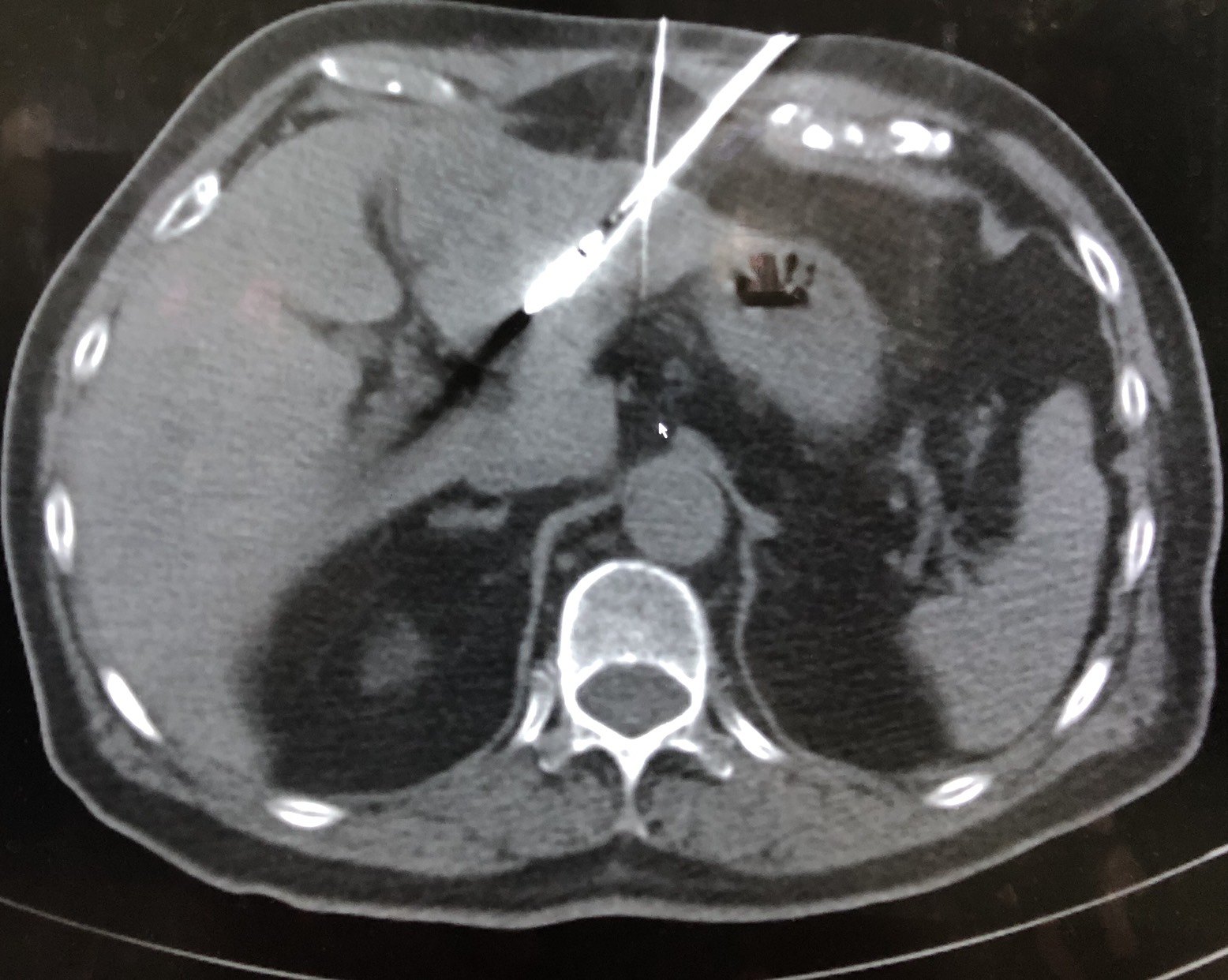 微波消融治疗左肝转移瘤