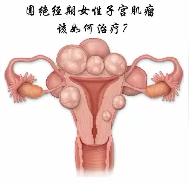 围绝经期女性子宫肌瘤该如何治疗?