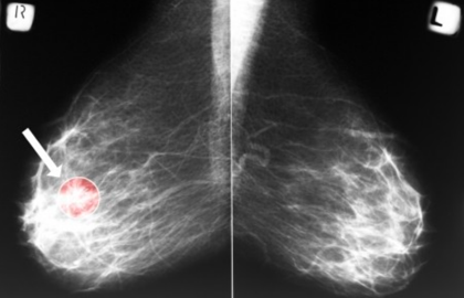 乳腺钙化灶会不会导致乳腺癌