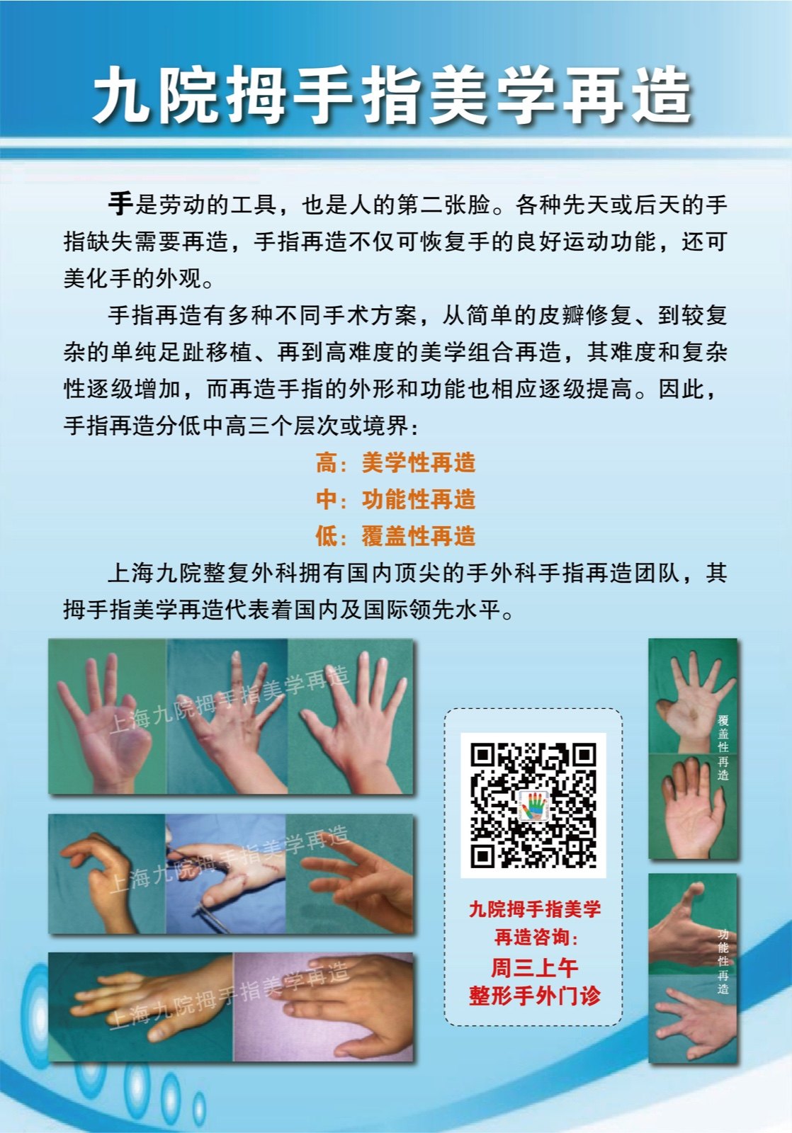 手指再造及案例集