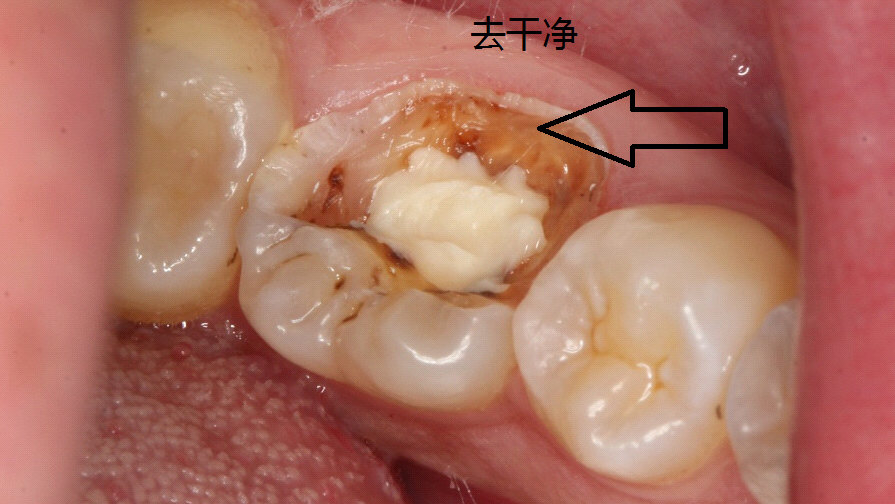 我是如何处理食物嵌塞