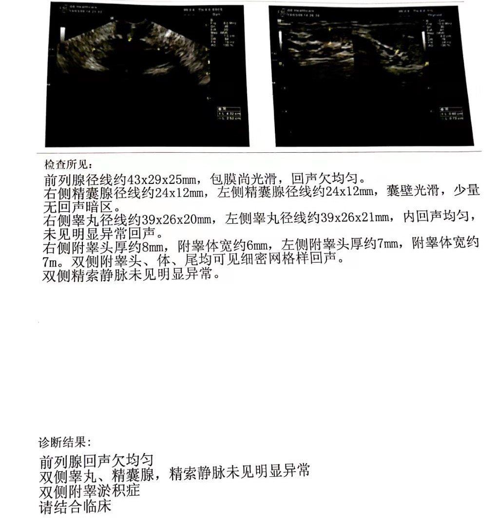梗阻性无精子症