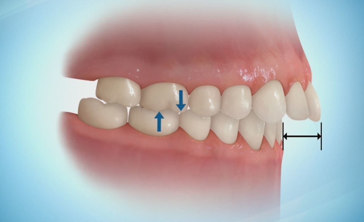 深覆盖有牙齿性,功能性以及骨性.在儿童替牙期及早的发现问题