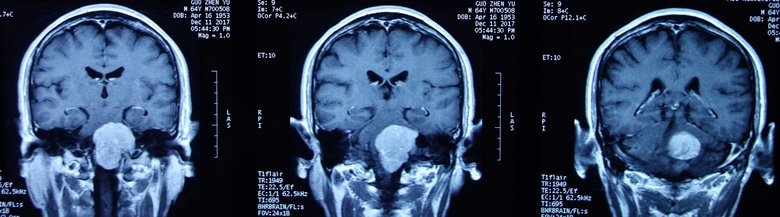 枕骨大孔脑膜瘤 后组颅神经功能保护