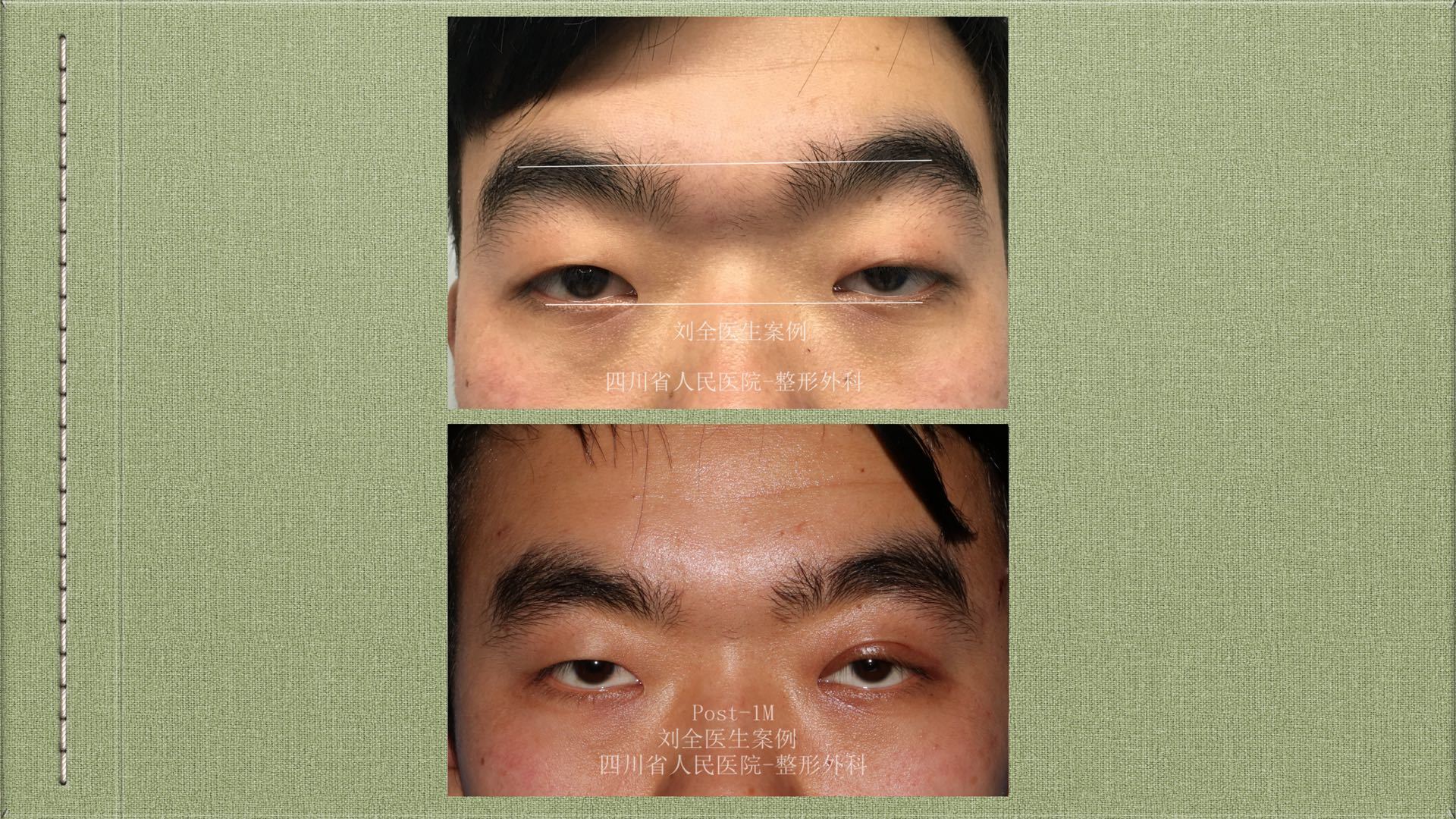 cfs~上睑下垂,用案例说话